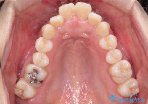 出っ歯で口が閉じずらい ワイヤー抜歯矯正の治療前