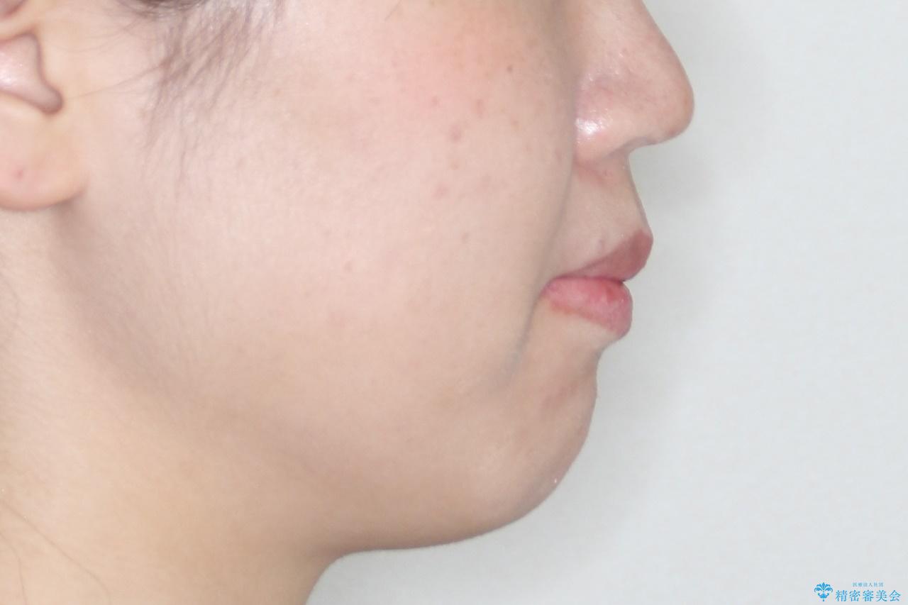 出っ歯で口が閉じずらい ワイヤー抜歯矯正の治療前(顔貌)