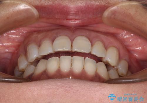 極端な上下前歯の開咬を改善　オープンバイトのインビザライン矯正の治療中