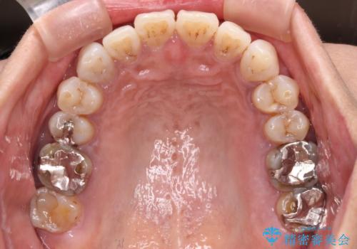 極端な上下前歯の開咬を改善　オープンバイトのインビザライン矯正の治療中