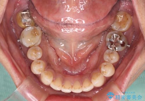極端な上下前歯の開咬を改善　オープンバイトのインビザライン矯正の治療中
