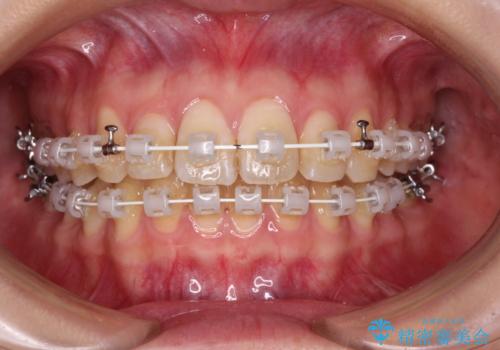 【モニター】飛び出した上顎前歯のワイヤー矯正で改善の治療中