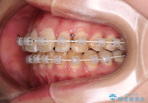 【モニター】飛び出した上顎前歯のワイヤー矯正で改善の治療中