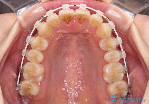【モニター】飛び出した上顎前歯のワイヤー矯正で改善の治療中