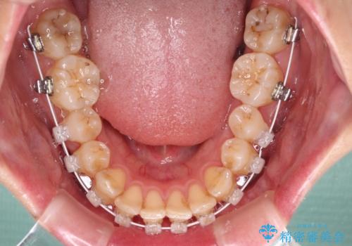 【モニター】飛び出した上顎前歯のワイヤー矯正で改善の治療中