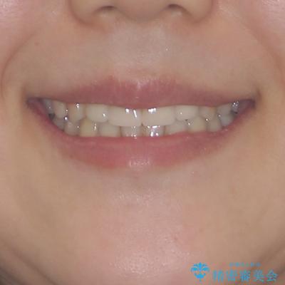 八重歯と開咬を治したい 目立たないハーフリンガル矯正の治療後(顔貌)