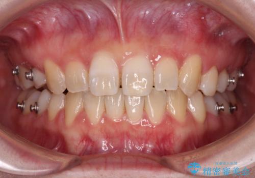 ディープバイトをインビザライン矯正で改善の治療中