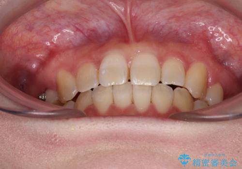 ディープバイトをインビザライン矯正で改善の治療中