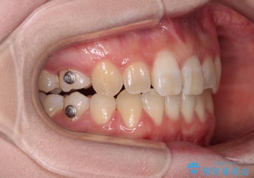 ディープバイトをインビザライン矯正で改善の治療中