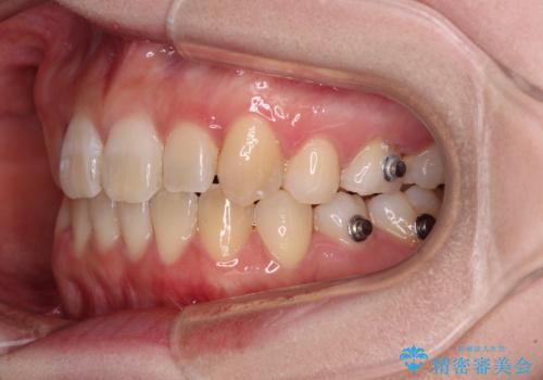 ディープバイトをインビザライン矯正で改善の治療中