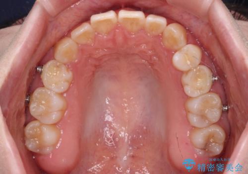 ディープバイトをインビザライン矯正で改善の治療中