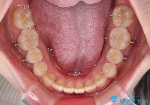 ディープバイトをインビザライン矯正で改善の治療中