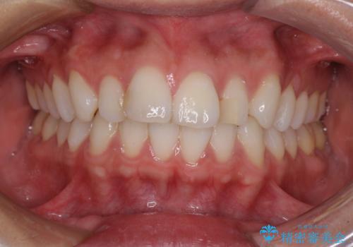 唇を閉じやすく　出っ歯の抜歯矯正の治療前