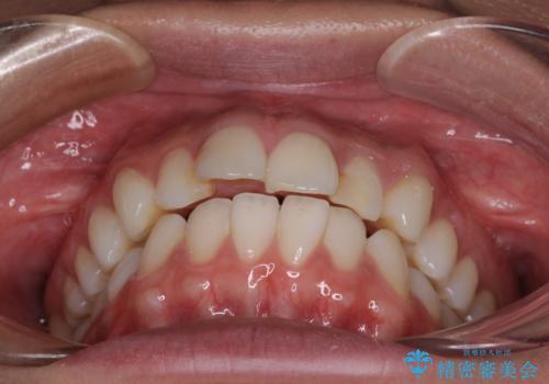 唇を閉じやすく　出っ歯の抜歯矯正の治療前
