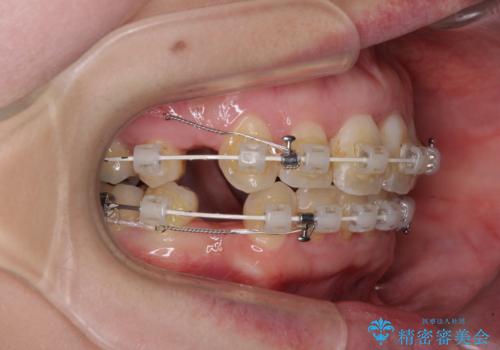 出っ歯による口の閉じにくさを治したい　ワイヤー装置を用いた抜歯矯正の治療中