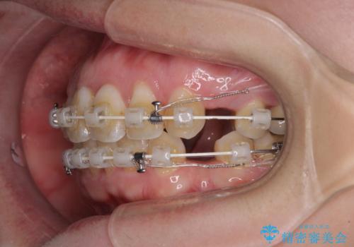 出っ歯による口の閉じにくさを治したい　ワイヤー装置を用いた抜歯矯正の治療中