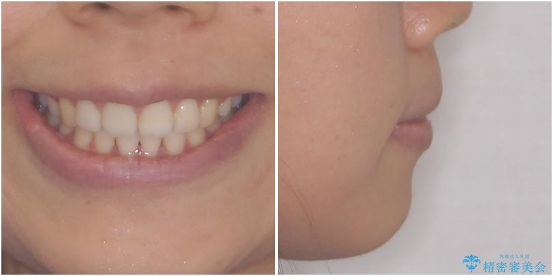 前歯の出っ歯と口の閉じにくさが気になる　目立たないワイヤー装置での抜歯矯正の治療後（顔貌）