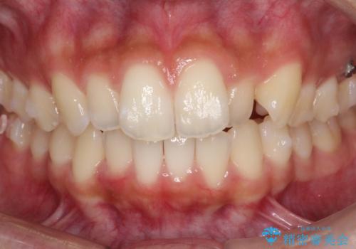 【前歯の見た目をキレイにしたい、引っ込んだ歯も気になる】インビザライン症例の治療中