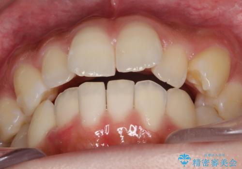 【前歯の見た目をキレイにしたい、引っ込んだ歯も気になる】インビザライン症例の治療中