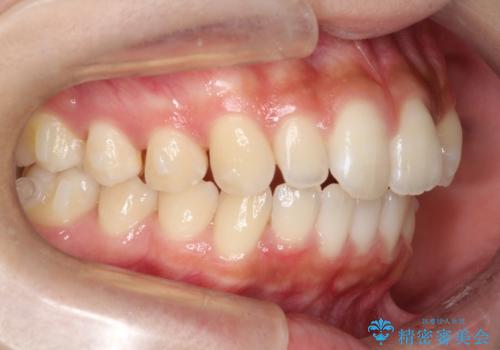 【前歯の見た目をキレイにしたい、引っ込んだ歯も気になる】インビザライン症例の治療中