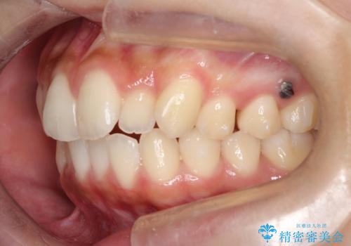 【前歯の見た目をキレイにしたい、引っ込んだ歯も気になる】インビザライン症例の治療中