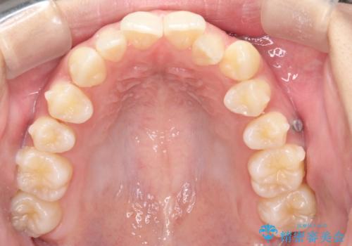 【前歯の見た目をキレイにしたい、引っ込んだ歯も気になる】インビザライン症例の治療中