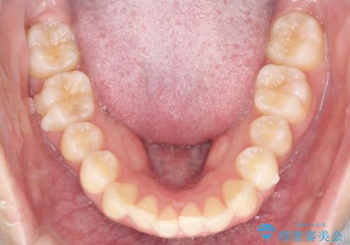【前歯の見た目をキレイにしたい、引っ込んだ歯も気になる】インビザライン症例の治療中