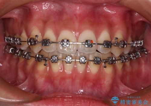 受け口と開咬を急速拡大装置とワイヤー装置で改善の治療中