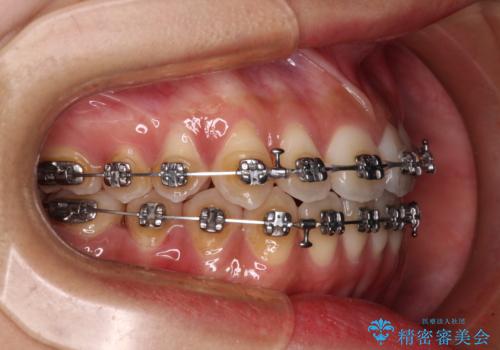 受け口と開咬を急速拡大装置とワイヤー装置で改善の治療中