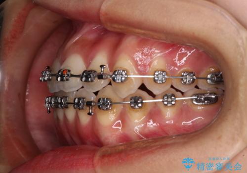 受け口と開咬を急速拡大装置とワイヤー装置で改善の治療中
