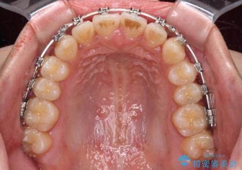 受け口と開咬を急速拡大装置とワイヤー装置で改善の治療中