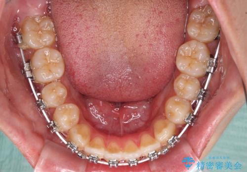 受け口と開咬を急速拡大装置とワイヤー装置で改善の治療中