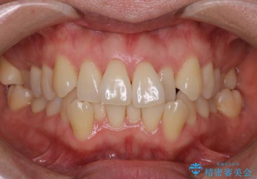 【抜歯ケース】前歯のガタガタをインビザラインで治療の症例 治療前