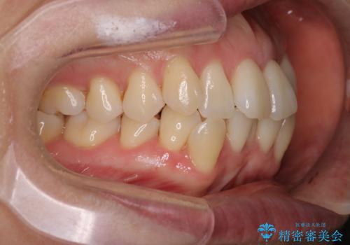 【抜歯ケース】前歯のガタガタをインビザラインで治療の治療前
