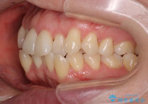 【抜歯ケース】前歯のガタガタをインビザラインで治療の治療前