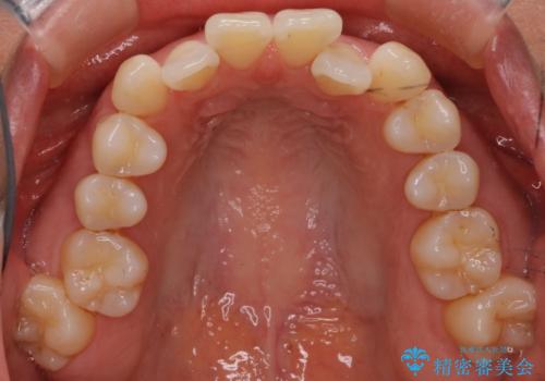 【抜歯ケース】前歯のガタガタをインビザラインで治療の治療前