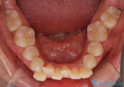 【抜歯ケース】前歯のガタガタをインビザラインで治療の治療前