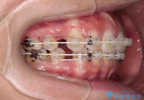 唇を閉じやすく　出っ歯の抜歯矯正の治療中