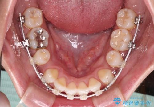 唇を閉じやすく　出っ歯の抜歯矯正の治療中