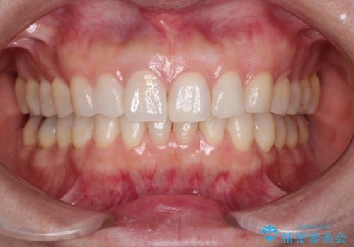 【オールセラミッククラウン】他院で入れた被せものがすぐとれるの治療後