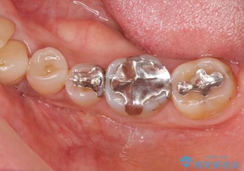 古くなった銀歯をやりかえたいの治療前