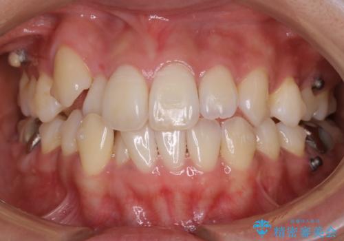 【非抜歯】インビザライン　隠れた前歯を並べる矯正治療の治療中