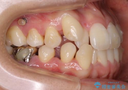 【非抜歯】インビザライン 隠れた前歯を並べる矯正治療の治療中