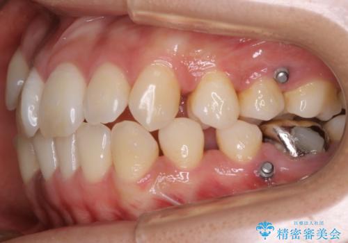 【非抜歯】インビザライン 隠れた前歯を並べる矯正治療の治療中