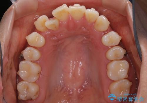 【非抜歯】インビザライン　隠れた前歯を並べる矯正治療の治療中