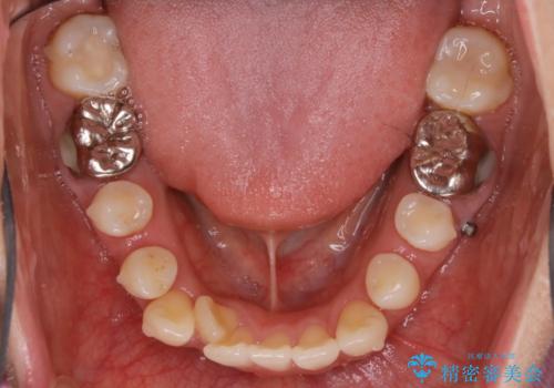 【非抜歯】インビザライン 隠れた前歯を並べる矯正治療の治療中