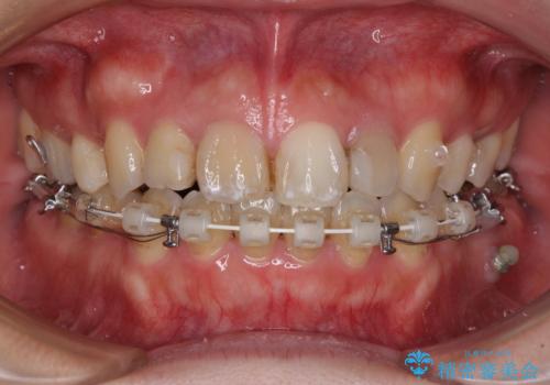 八重歯と開咬を治したい 目立たないハーフリンガル矯正の治療中