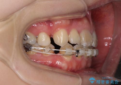 八重歯と開咬を治したい 目立たないハーフリンガル矯正の治療中