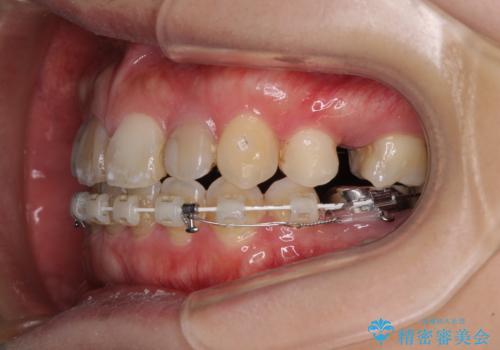 八重歯と開咬を治したい 目立たないハーフリンガル矯正の治療中