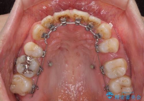八重歯と開咬を治したい 目立たないハーフリンガル矯正の治療中